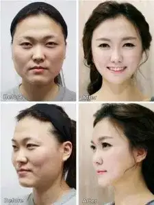 Korean_cosmetic_surgery